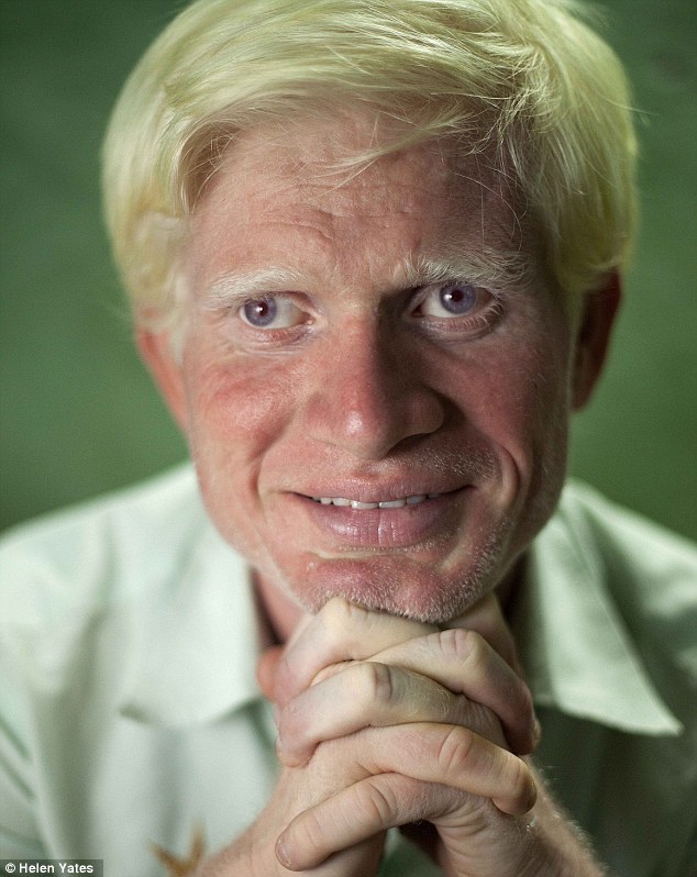 世界上最大的白化病家庭