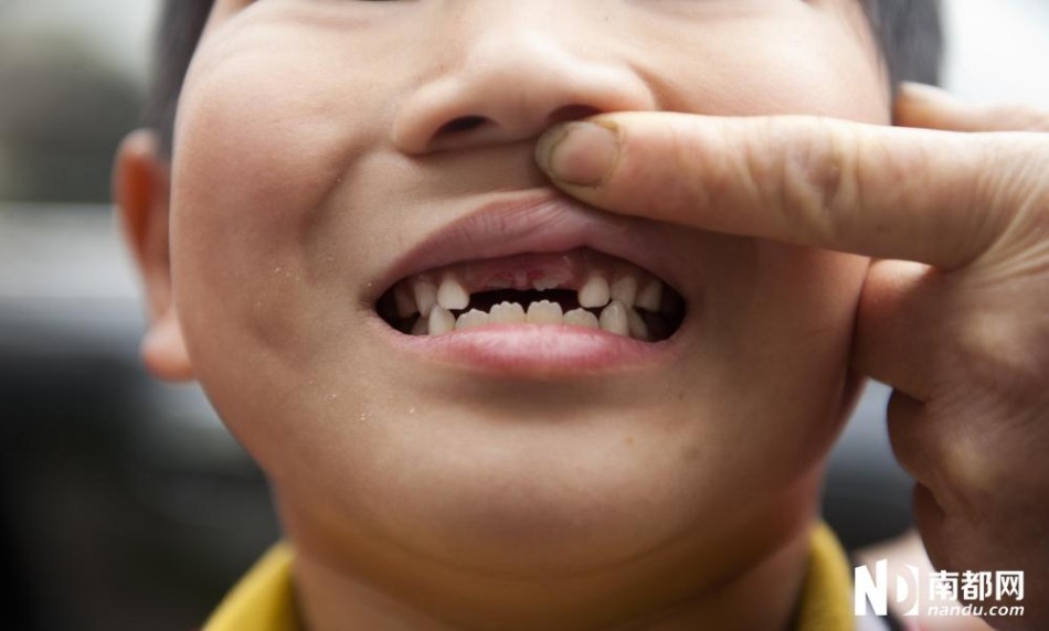 小学生上课调皮被老师打断门牙