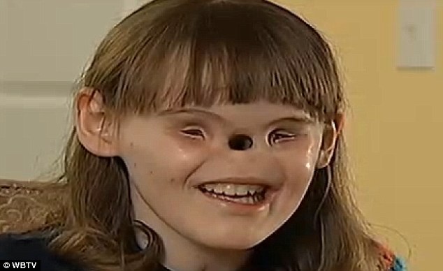 美国女子天生缺眼睛鼻子将接受整容