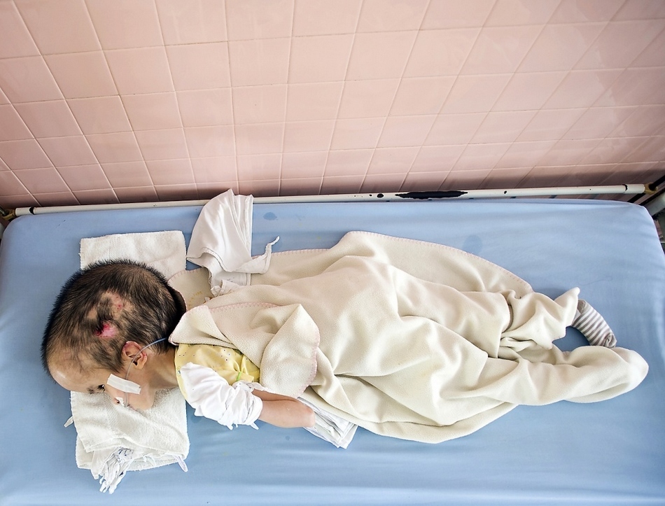 越战遗毒:"橙剂"阴影下的越南儿童