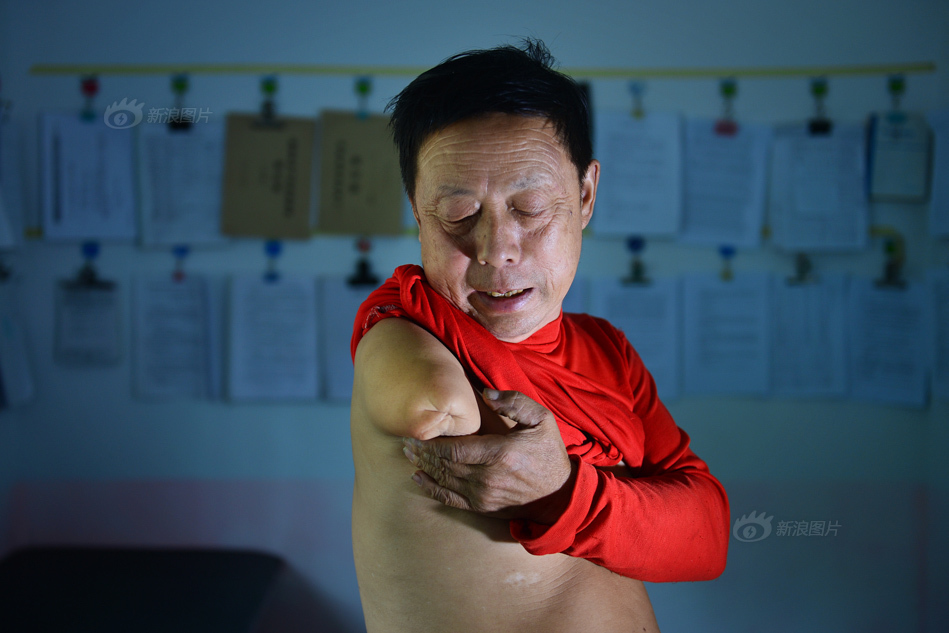 大山深处的"独臂村医"