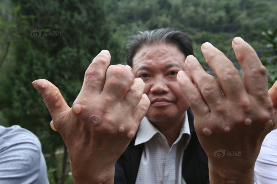 广西河池农民患怪病 手脚长硬块_高清图集_新浪网