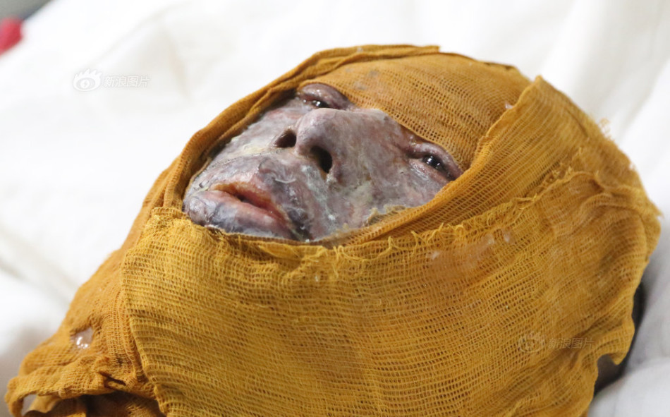 湖南一派出所副所长为救自焚男子重度烧伤_高清图集_新浪网