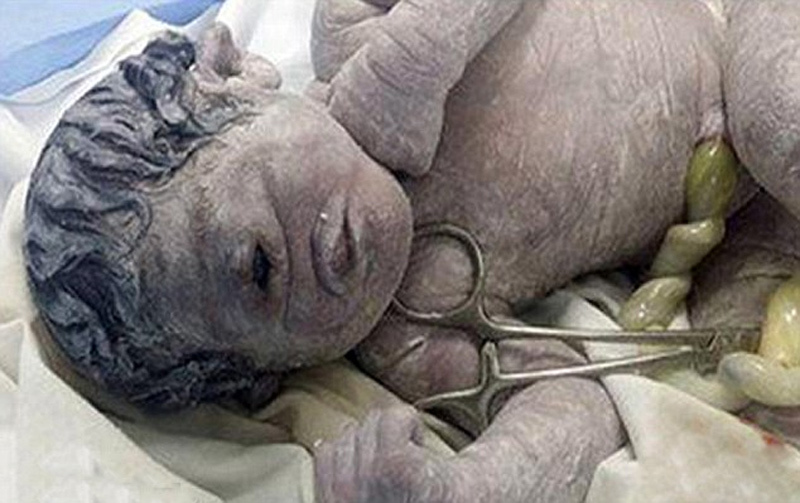 埃及新生婴儿只有一只眼 或受放射物影响