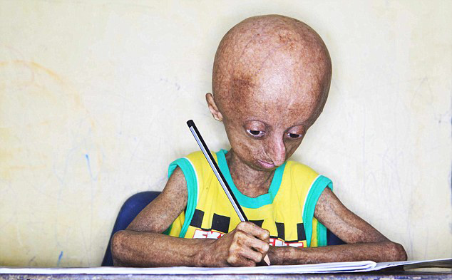 14岁少年患早衰症 老化速度是同龄人8倍