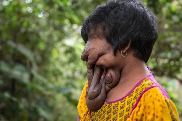 印度女孩得怪病 脸遭皮肤"吞噬"