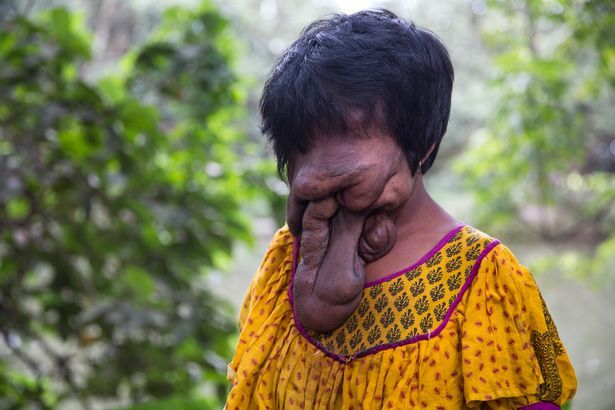 印度女孩得怪病 脸遭皮肤"吞噬"