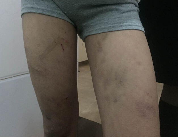 四川11岁女孩被养父母虐待 遭刀割针扎