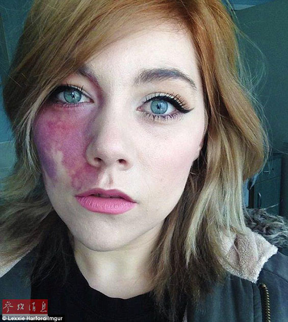 英国女子网上晒胎记走红 右脸似伤疤