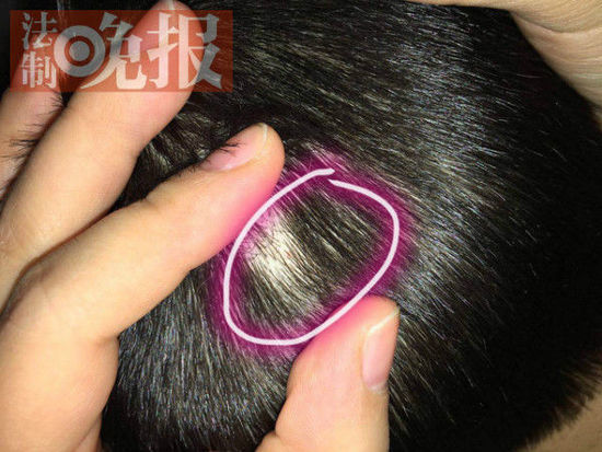 沈阳一儿童被扎50针 幼儿园30人身上有伤