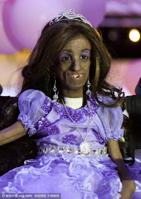 早衰症少女庆祝15岁生日