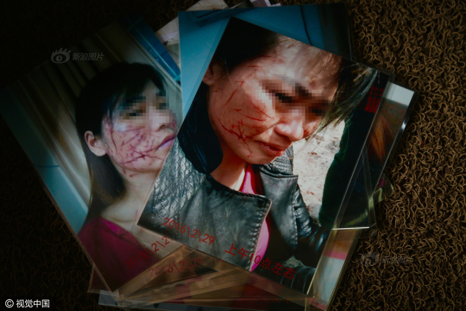 原配被老公和小三"划百刀" 几近毁容