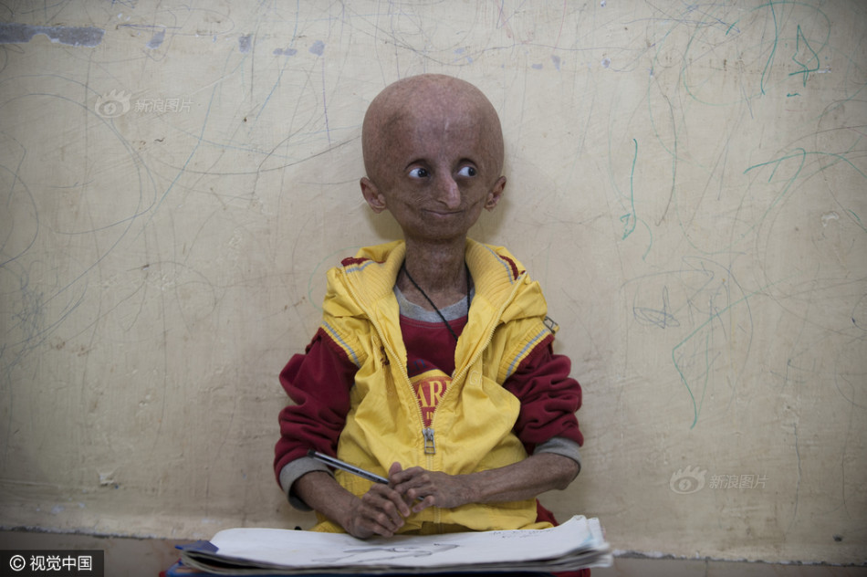 最长寿早衰综合症男去世