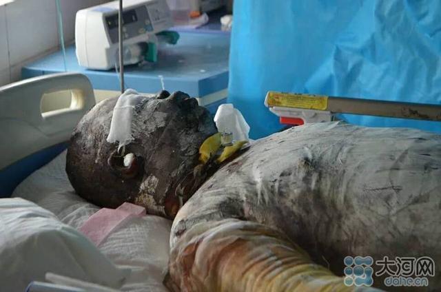 男子三入火海救人被烧成"炭人"