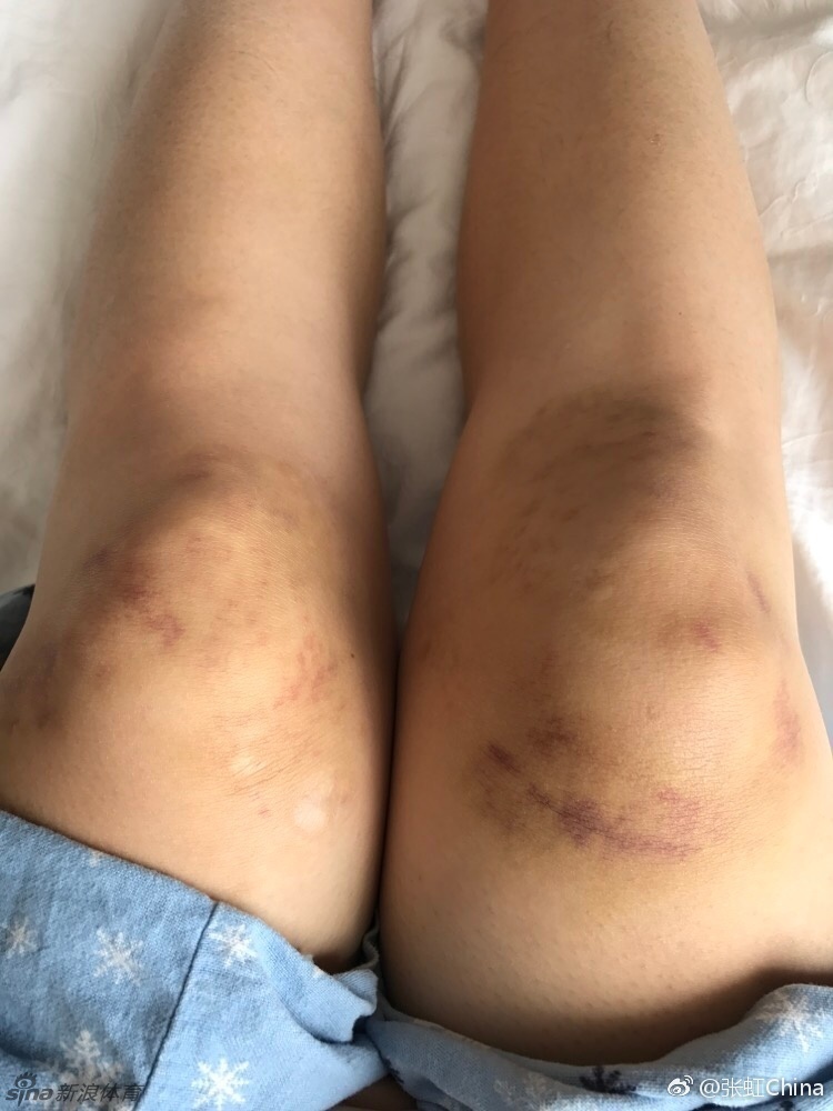 速滑女神张虹双膝青紫惹人心疼_高清图集_新浪网