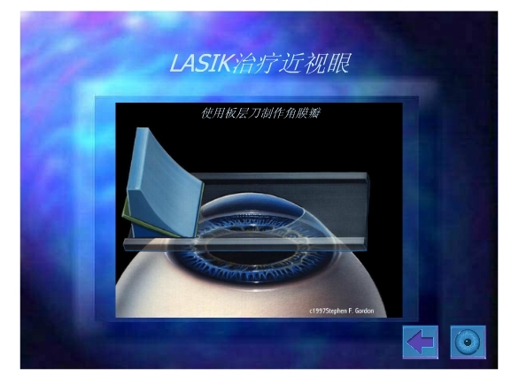 详细图解:激光近视矫正手术lasik