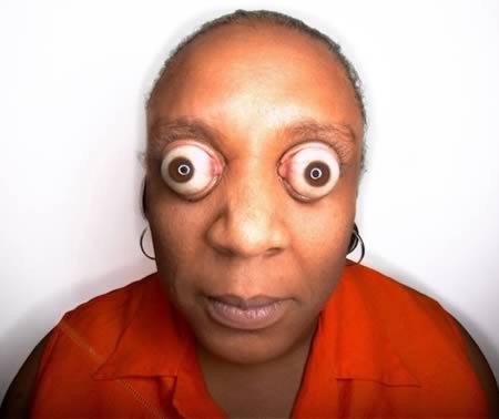 球面具重击头部以后,眼球就这样喷出来一点点;从此只要打个哈欠,眼睛