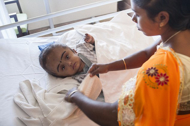 印巨头女婴术后头围缩小恢复良好_高清图集_新浪网