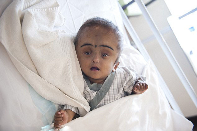 1 / 10 印度年仅2岁的大头女婴罗娜(roona)因患有先天性脑积水,其头部