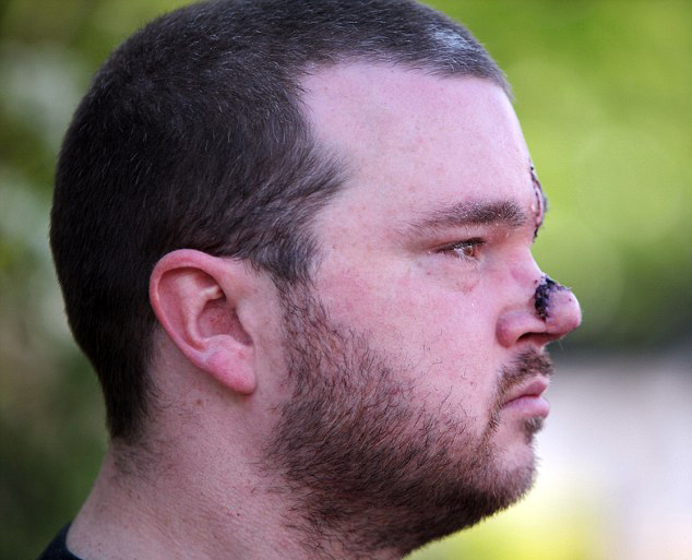 英男子鼻子被人咬掉用前额皮肤修复整形