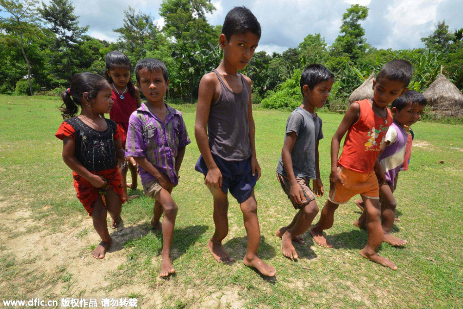 印度村庄多名村民氟中毒