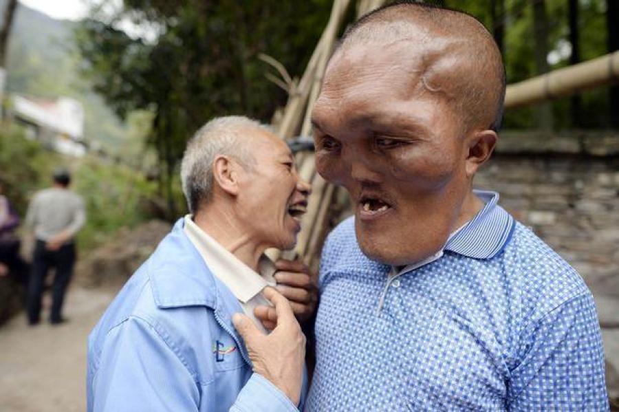现实异形 男子患怪病面部增大似外星人_健康养生_武进新闻网