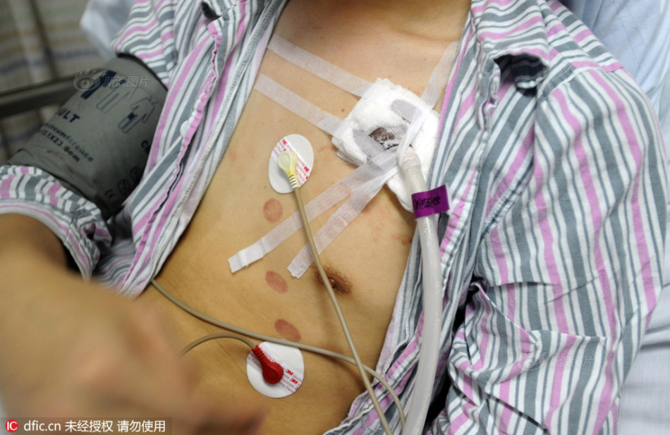 图为2016年7月27日,重庆大坪医院,胸部插着管子的重庆力帆球迷罗先生