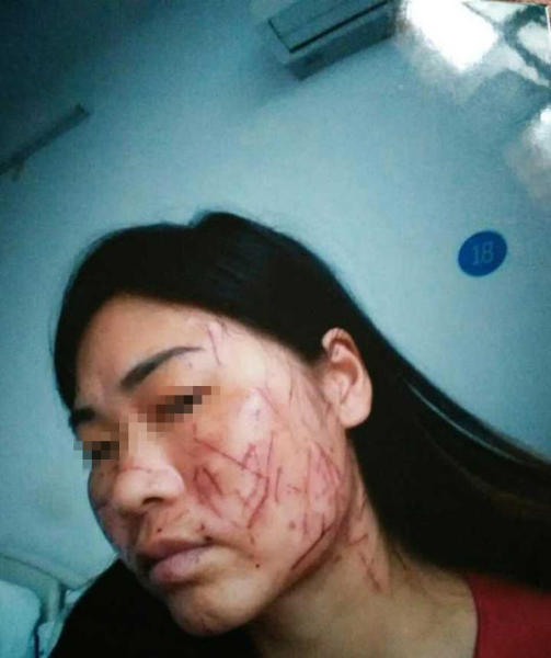 来人用刮眉毛和削水果的小刀往景的左右脸颊,鼻部等处,划了满脸刀伤