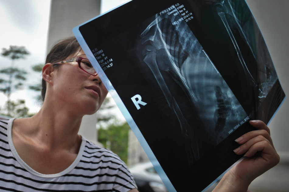 4岁儿童幼儿园内疑被老师扭断右手