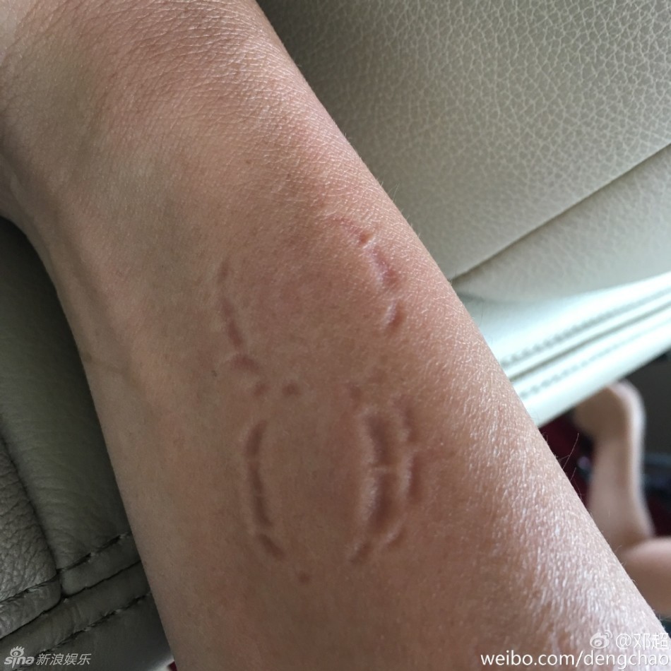 组图:邓超被女儿小花咬手腕 两大牙印清晰可见_高清图集_新浪网