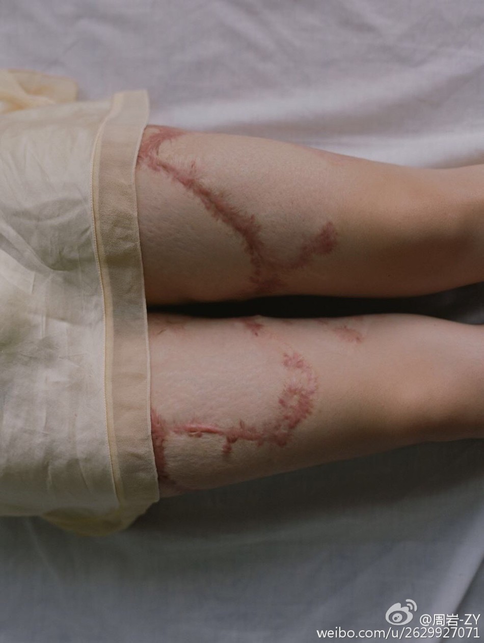 组图:勇敢却令人心疼!烧伤女孩浴火重生拍写真