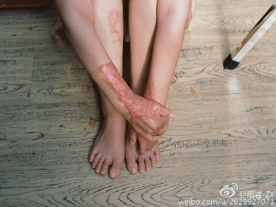 组图:勇敢却令人心疼!烧伤女孩浴火重生拍写真