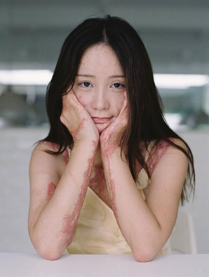 组图:勇敢却令人心疼!烧伤女孩浴火重生拍写真