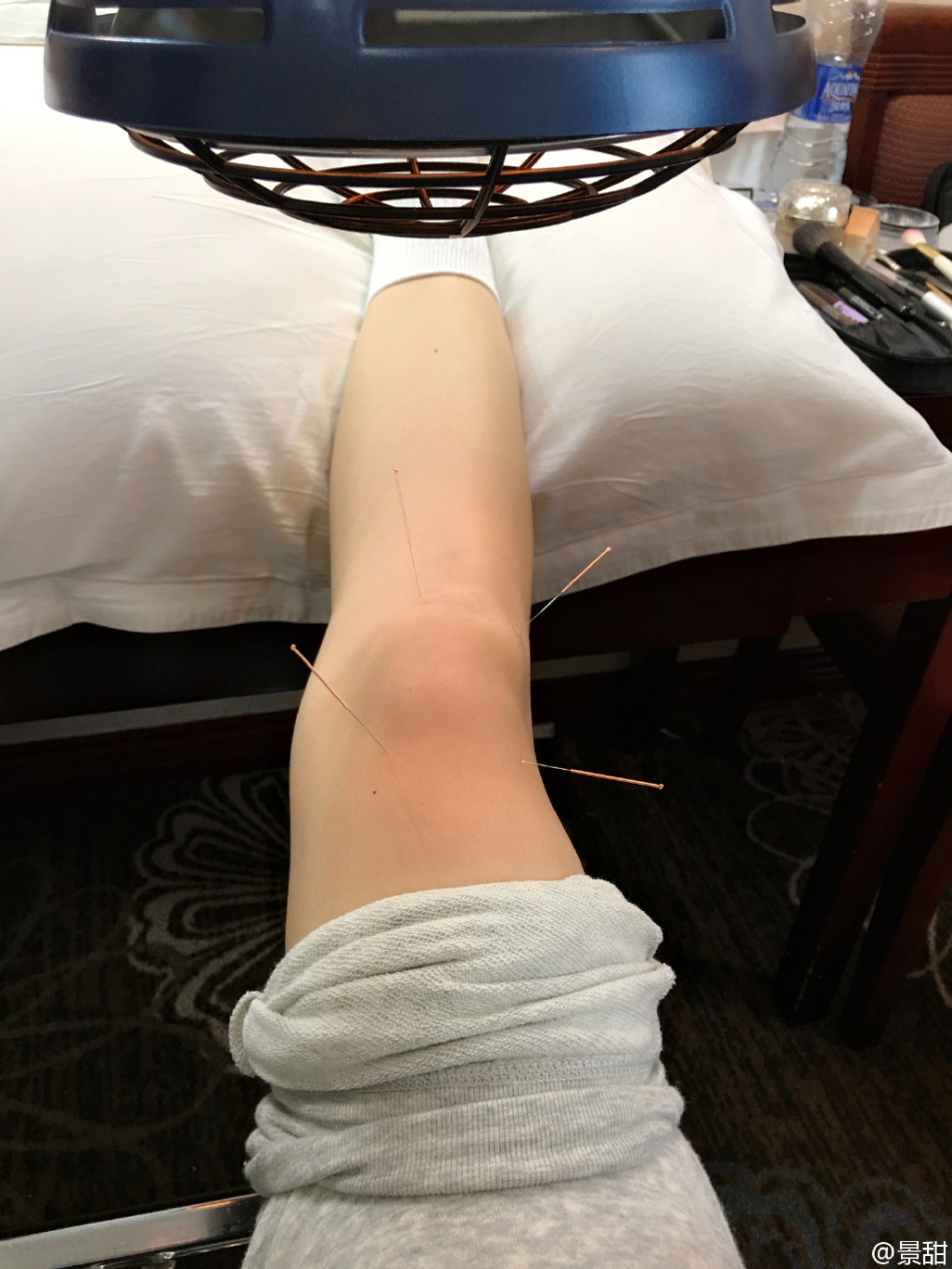 景甜拍打戏落下后遗症针灸理疗