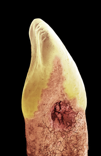 牙齿蛀虫图片显微镜图片