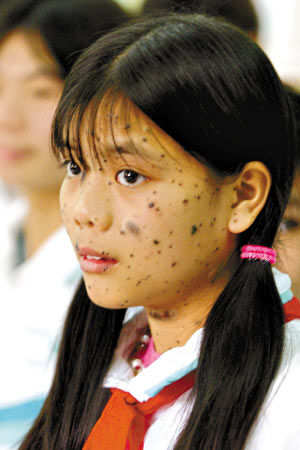 越南橙剂受害者图片图片