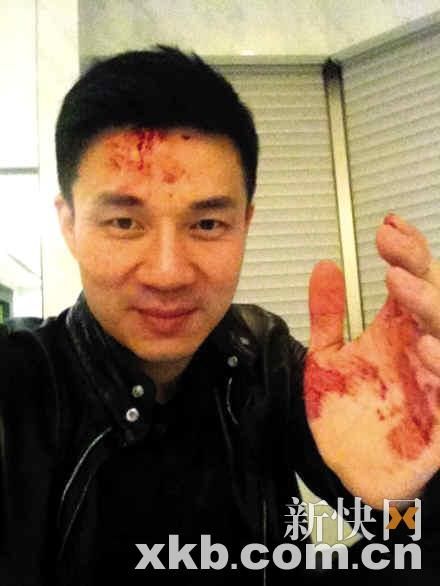 小s老公撞柱子头破血流伤口约两三厘米 图 手机新浪网