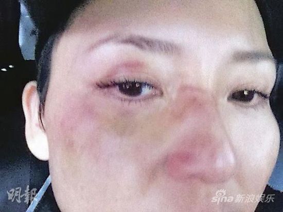 刘美君出外景受伤微博曝伤照 鼻歪满脸瘀伤 手机新浪网