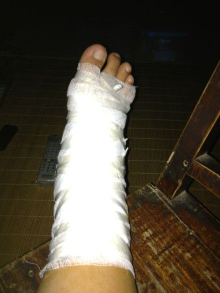 粉丝捧场脚骨断裂获叶童夫妇微博祝福