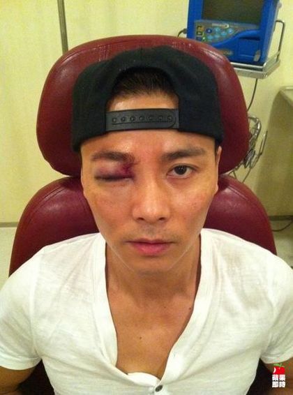 张晋拍戏右眼被打伤