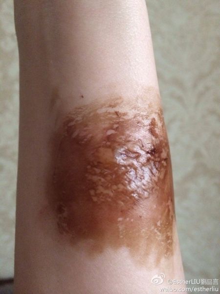 刘品言聚餐遭三度烫伤 自称反面教材(图)