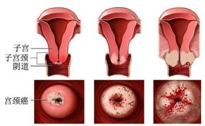 “糜烂”真相：上皮很薄可见血管
