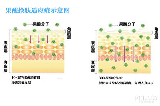 如何选择适合的果酸