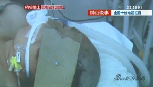 狠毒丈夫为骗巨额保险在妻子头上打钢钉