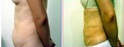 共振吸脂减肥效果图