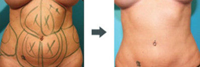 水动力吸脂减肥效果图