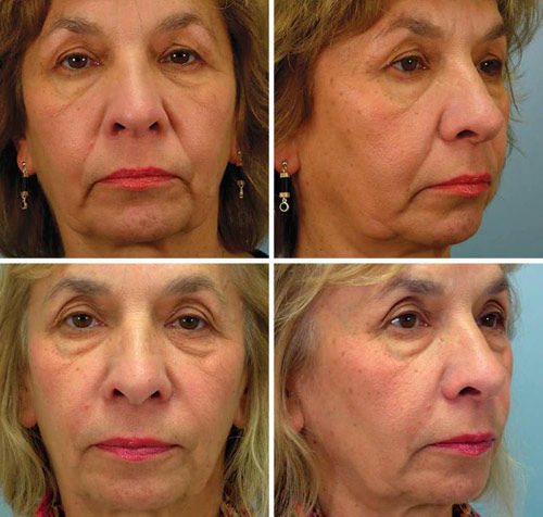 悬吊线面部提升，术前术后对比照。