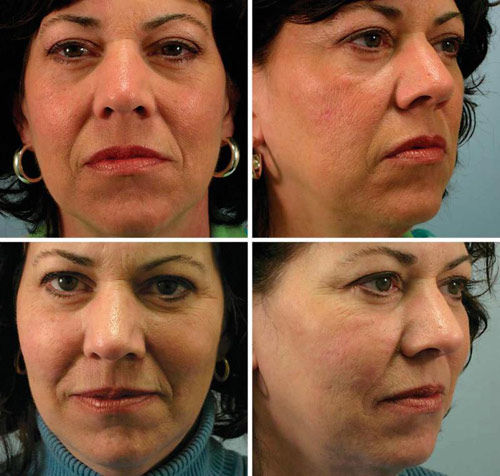 悬吊线提升术加脂肪移植，术前术后对比照。