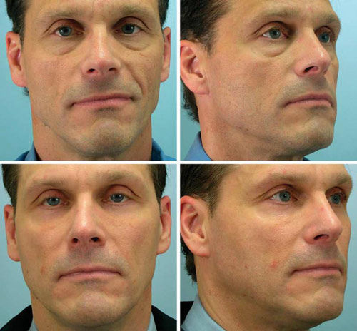 下睑整形及下睑和中面部脂肪移植，术前术后对比照。