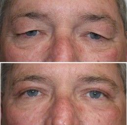 上眼睑的衰老变化